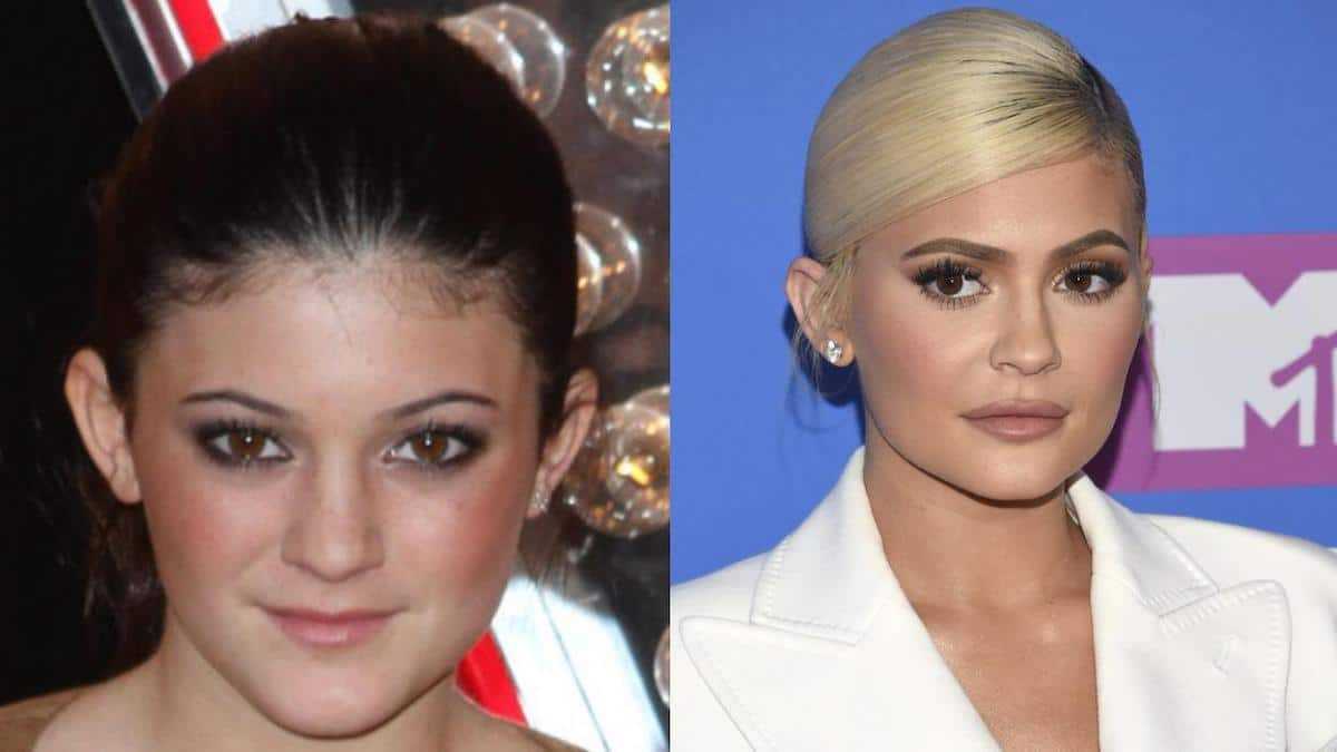 Ces célébrités avant et après les opérations de chirurgie esthétique