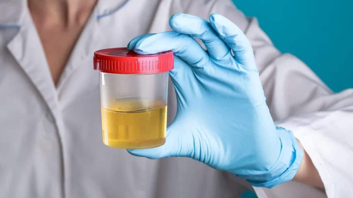 Alzheimer : un test urinaire pourrait bientôt dépister la maladie précocement