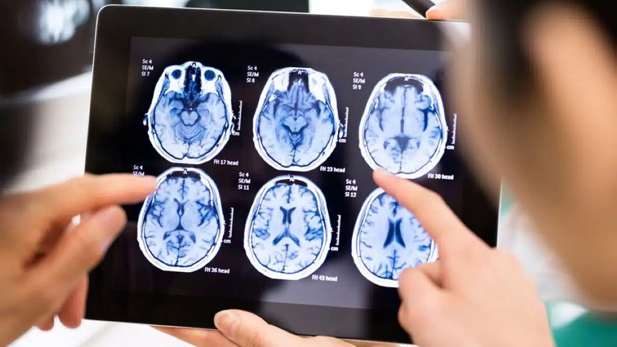Glioblastomes, tumeurs cérébrales : quelle est espérance de vie d’une personne atteinte ?
